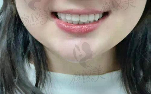 瓷贴面22c_meitu_6.jpg