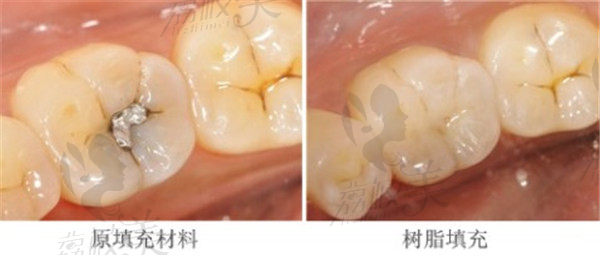 传统补牙和3M树脂补牙区别