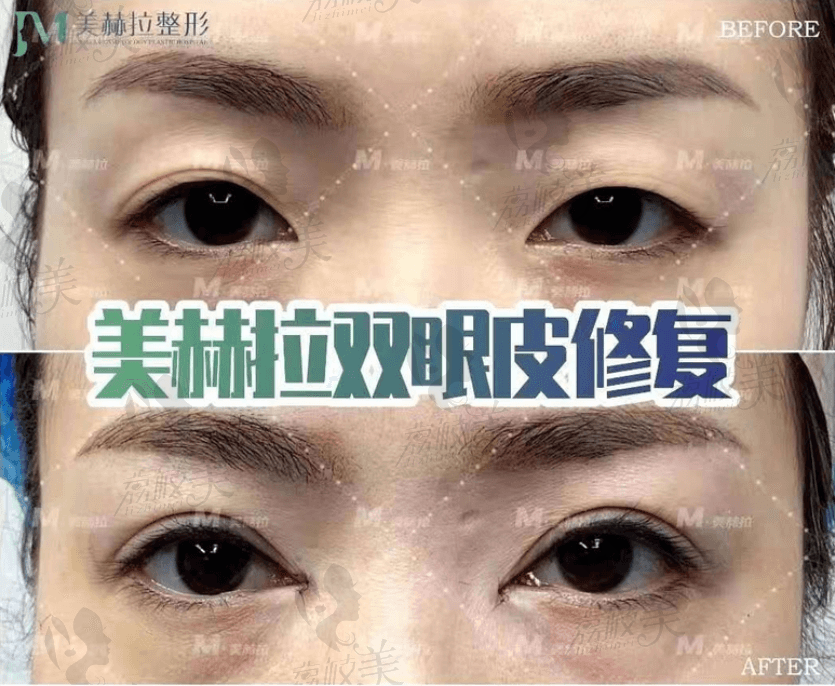 西安吉美赫拉双眼皮修复<span style=