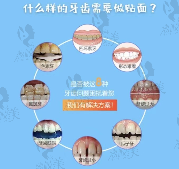 什么样的牙齿需要做贴面?