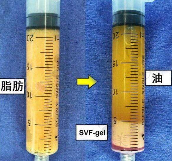 SVF自体活细胞面部移植术