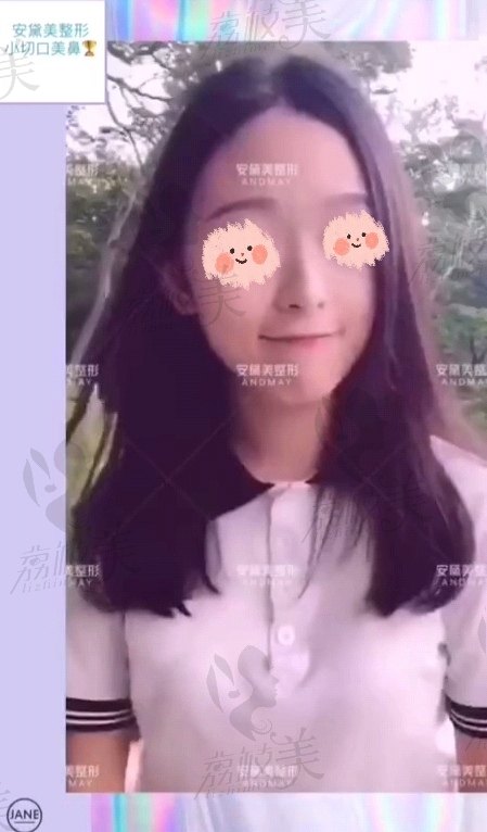 安黛美的小切口隆鼻术后照