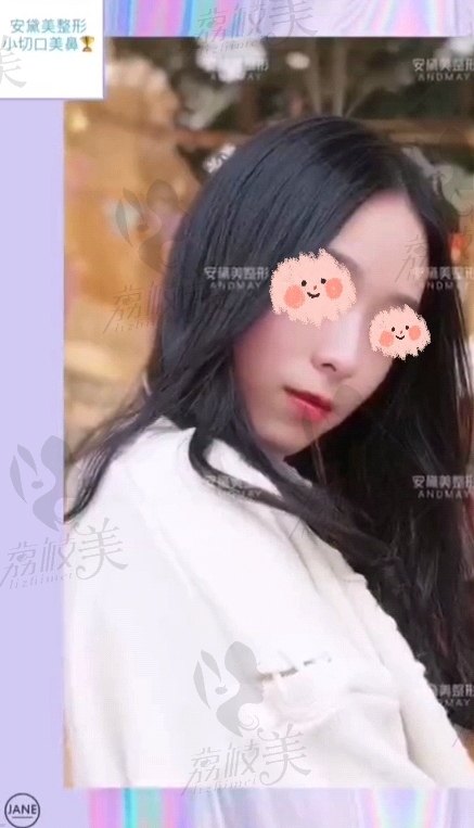 安黛美的小切口隆鼻术后照