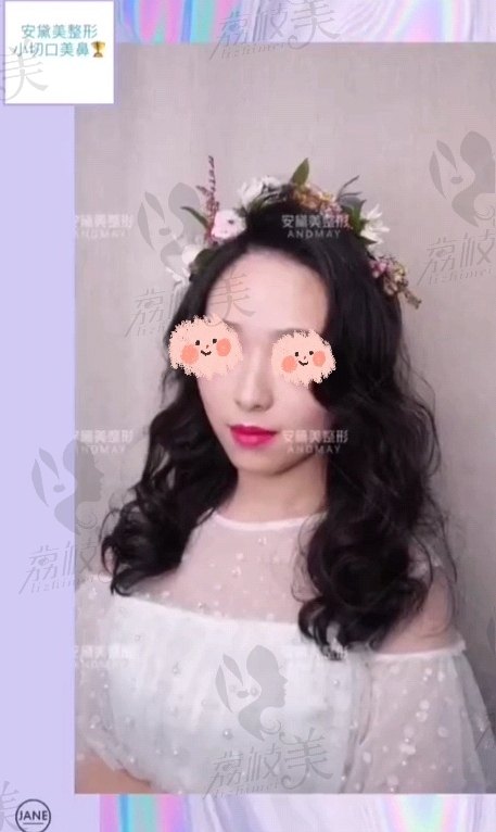 安黛美的小切口隆鼻术后照