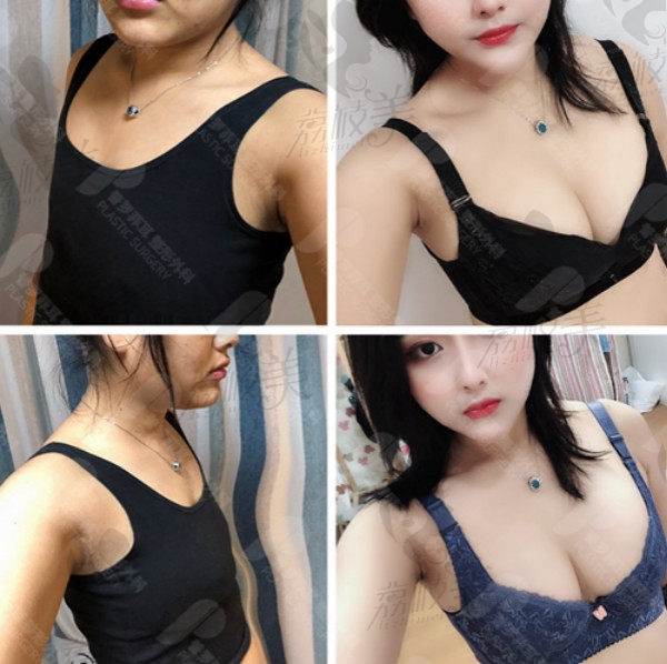 郑在皓院长假体隆胸案例对比