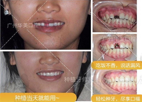 广州华美口腔登腾种植牙案例