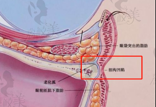 杭州圣茜嗨体熊猫针