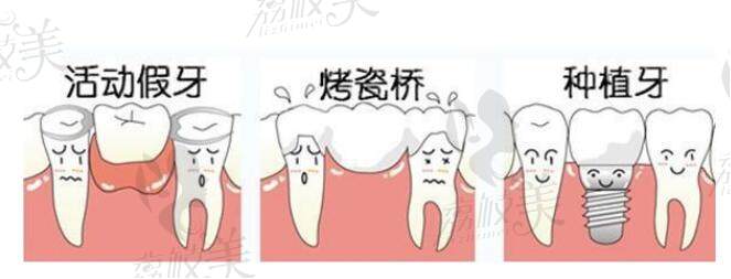 牙缺失修复有三种方式：