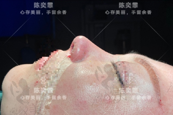 长沙卓而美陈奕霏的半肋鼻综合术后