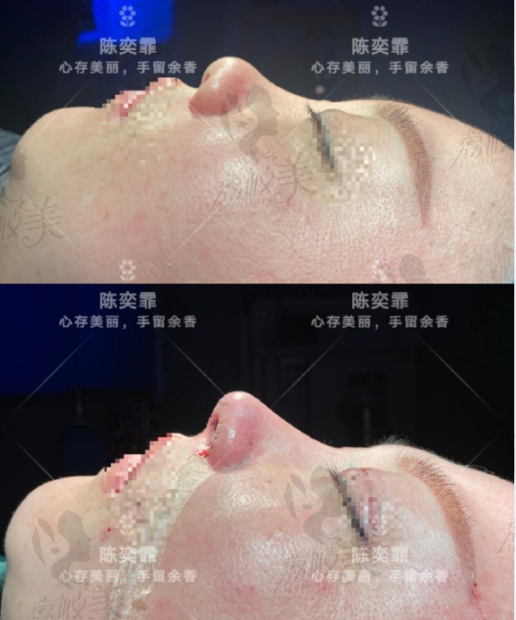 长沙卓而美陈奕霏的半肋鼻综合术前后对比