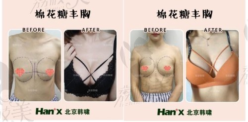 太瘦做假体隆胸很硬吗!看北京韩啸90斤女孩棉花糖丰乳案例!