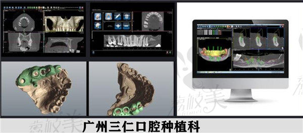 广州三仁口腔数字化种植技术展示