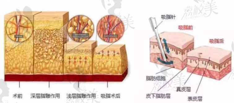 北京薇琳全身吸脂