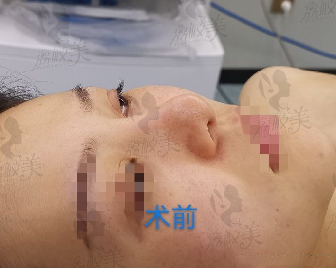 成都天后郭世伟院长半肋鼻综合术前