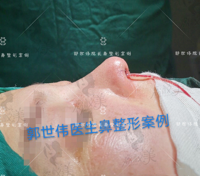 成都天后郭世伟院长半肋鼻综合术后即刻