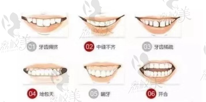 常见的几种牙齿问题