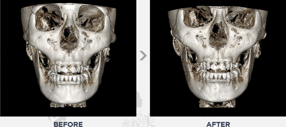 韩国美迪莹整形外科无金属无下垂颧骨缩小术前后对比CT