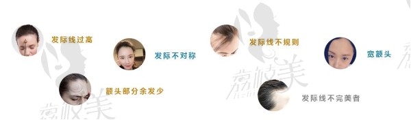 河南高科发际线种植,无痕微针技术调整 保证98%毛囊成活率!