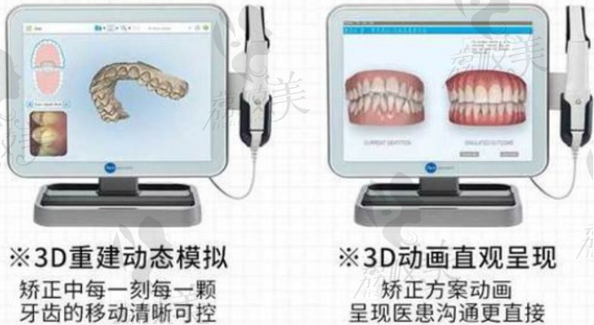 3D动态模拟牙齿矫正