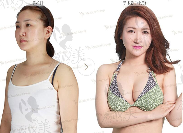 韩国JK整形外科假体隆胸案例