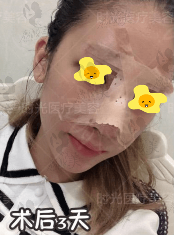桂林时光综合隆鼻术后3天