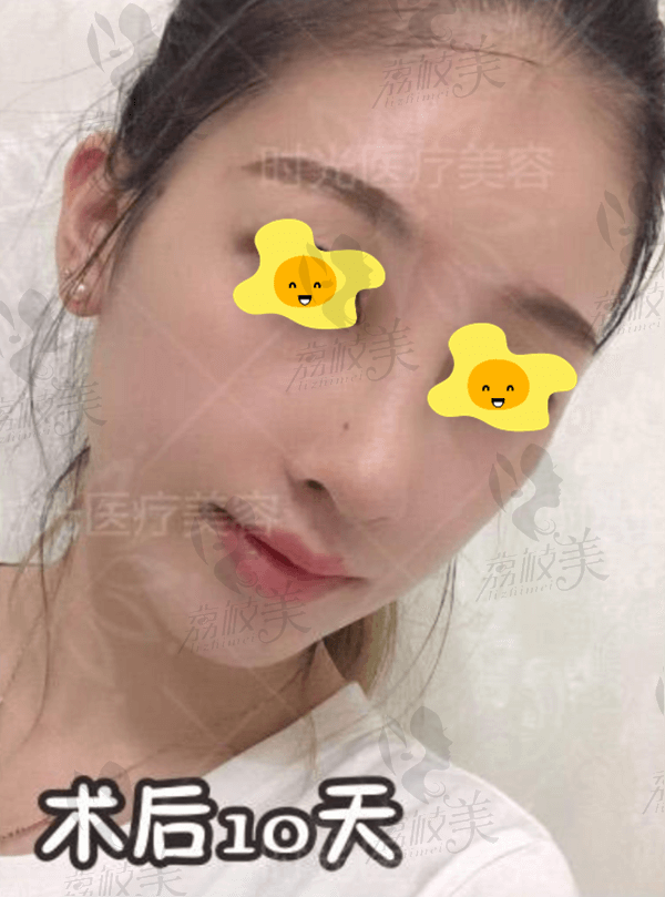 桂林时光综合隆鼻术后10天
