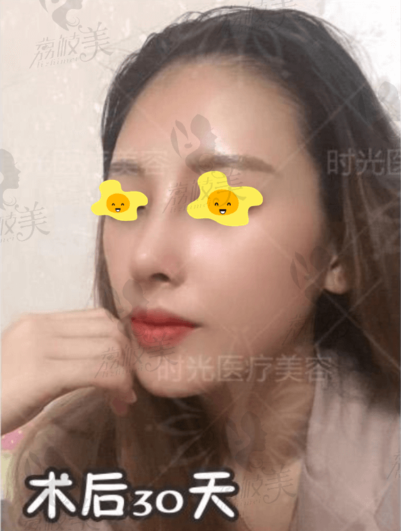 桂林时光综合隆鼻术后30天