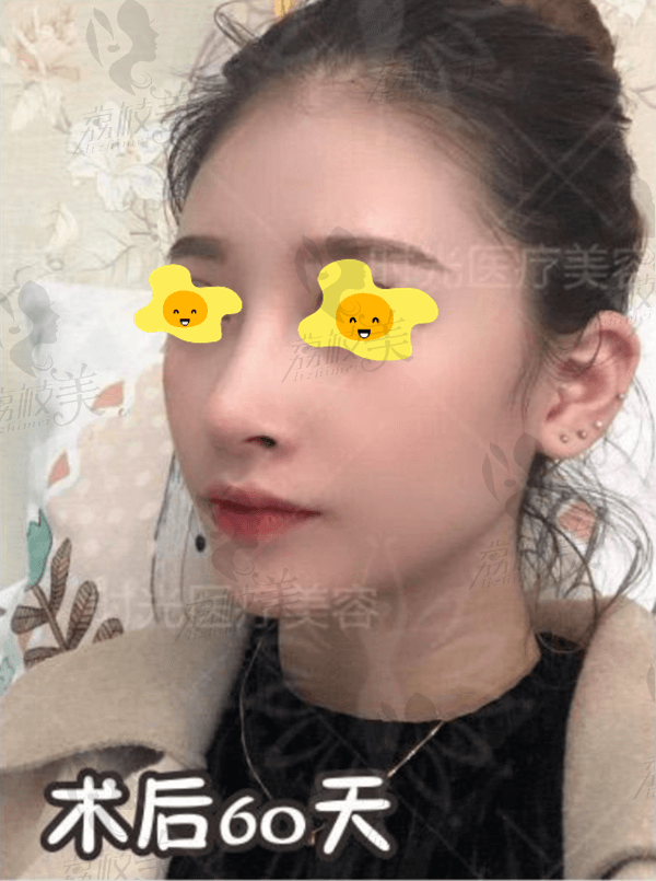 桂林时光综合隆鼻术后60天