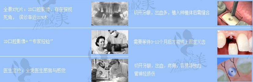 传统种植牙