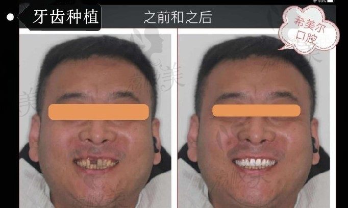 大叔种植牙案例