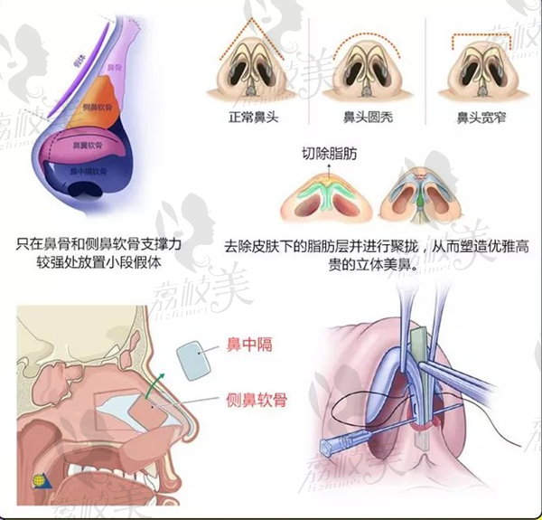 长沙脸博士3V鼻穹隆超精联生植入术