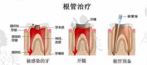 根管治疗