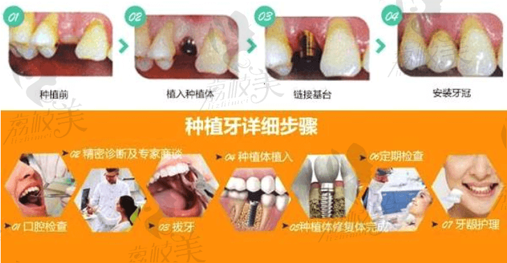 麒麟口腔种植牙流程