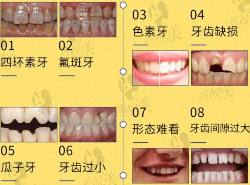 牙齿形态色泽缺陷