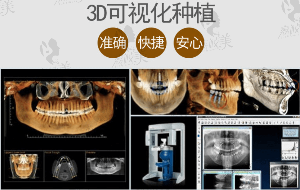 爱思特牙齿种植