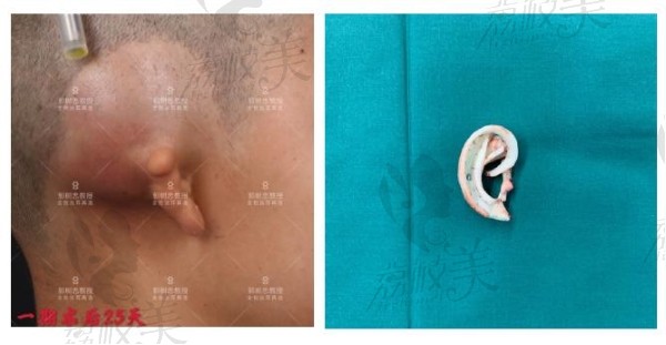 中国耳畸形哪个医生做的好?西安郭树忠耳再造一期手术案例图