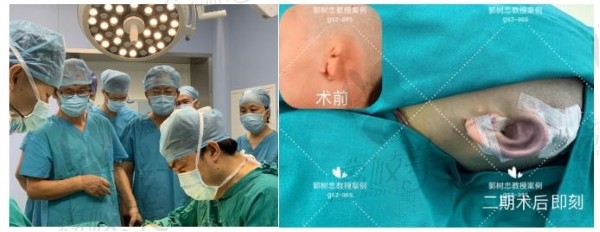 中国耳畸形哪个医生做的好?西安郭树忠耳再造二期手术案例图