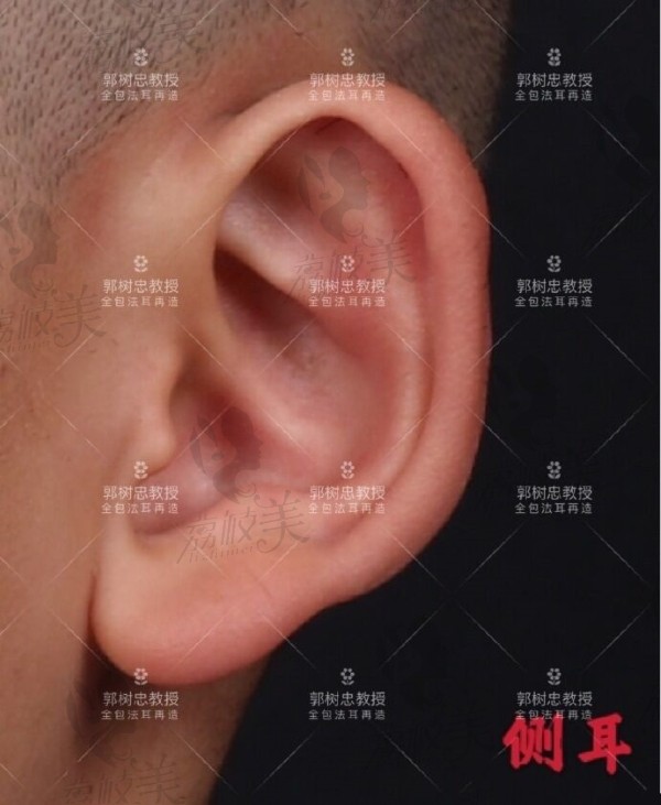 中国耳畸形哪个医生做的好?西安郭树忠耳再造三期手术案例图