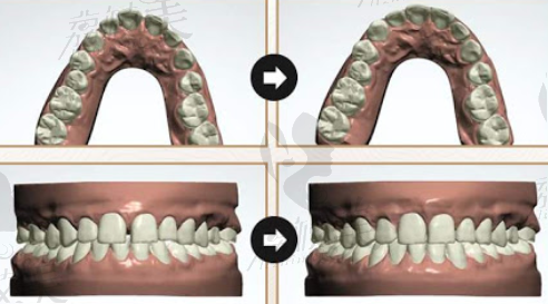 3D模拟牙齿矫正