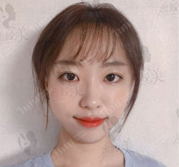 韩国1mm自然款双眼皮术后