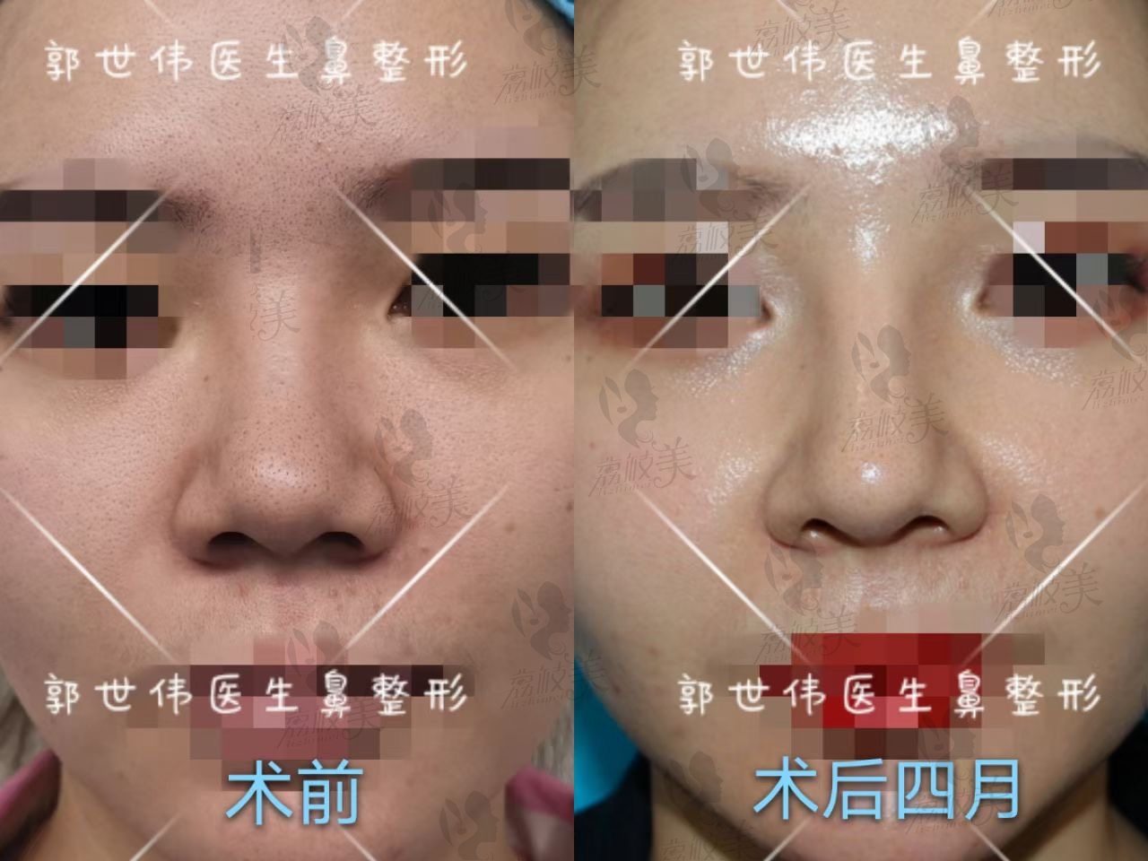 成都天后郭世伟鼻修复<span style=