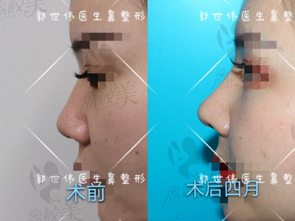 成都天后郭世伟鼻修复<span style=
