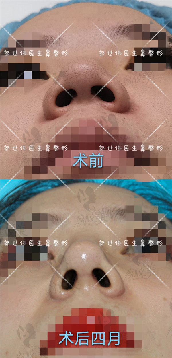 成都天后郭世伟鼻修复<span style=