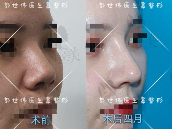 成都天后郭世伟鼻修复<span style=