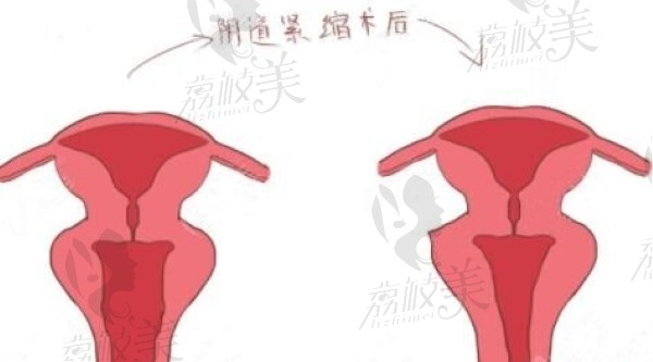 西安陈娟的4d生物束带阴道紧缩术怎么样