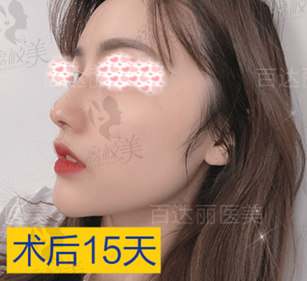 重庆百达丽李茂群的肋软骨隆鼻术后15天