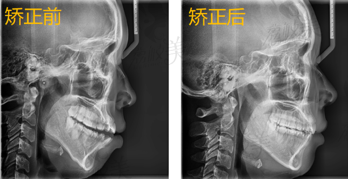 牙齿矫正前后的侧面对比图
