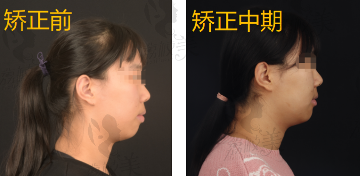 牙齿矫正前后的侧面对比图