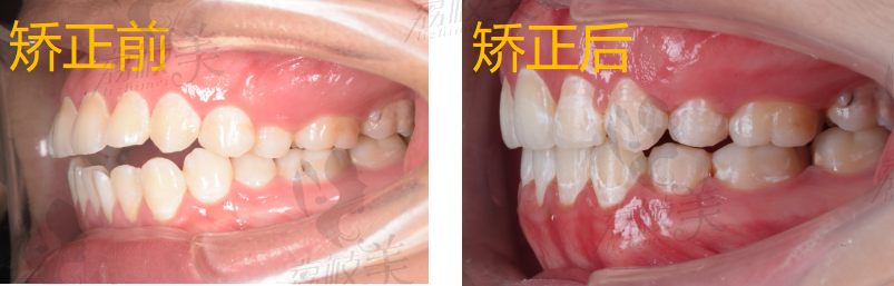 牙齿矫正前后的侧面对比图