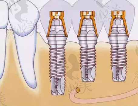 种植牙示意图